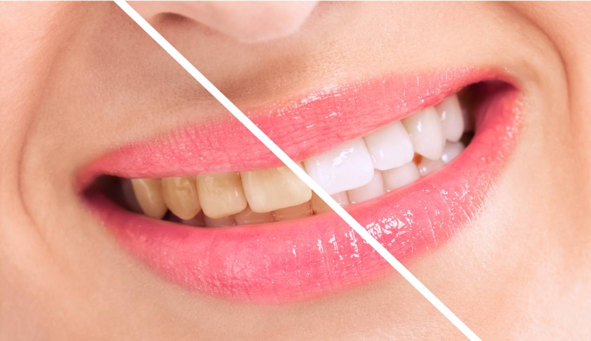 How Much Does Teeth Whitening Cost?