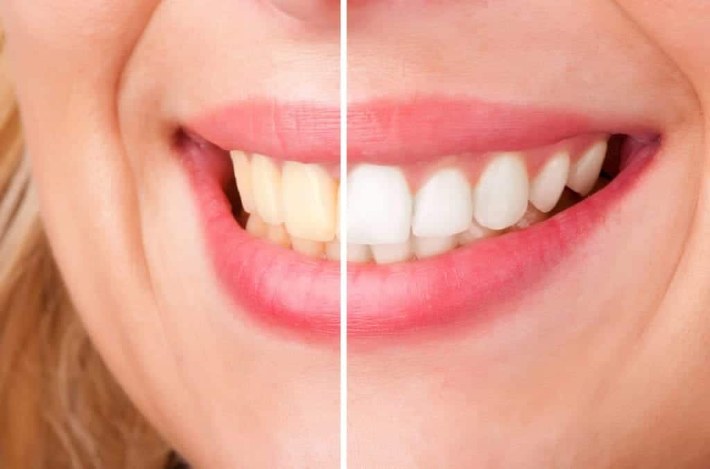 How Much is Teeth Whitening?