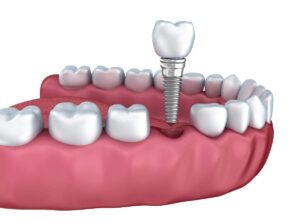 how to find affordable dental implants